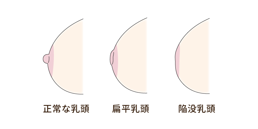 乳頭タイプ3種類